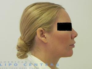 americanlipocenters_147.jpg